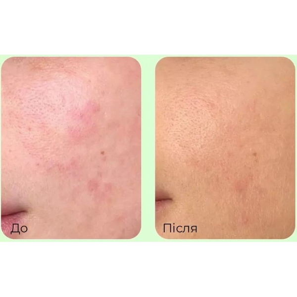 Заспокійливий крем з PDRN і центеллою MEDIPEEL Young Cica PDRN Trouble Soothing Cream, 80 мл 12323 фото